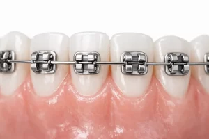 brackets metálicos