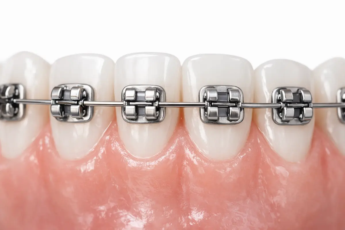 brackets metálicos
