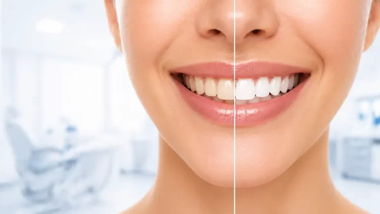 carillas vs blanqueamiento