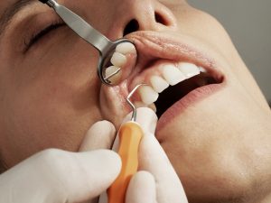 Retenedores después de ortodoncia - Clínica Dental Paraíso Carmona