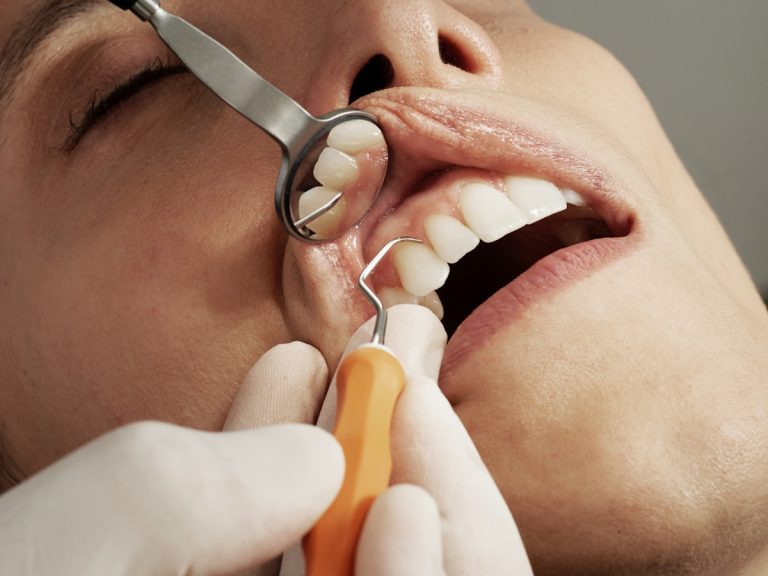 Retenedores después de ortodoncia - Clínica Dental Paraíso Carmona